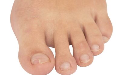 When Does an Ingrown Toenail Require a Visit to the Podiatrist?