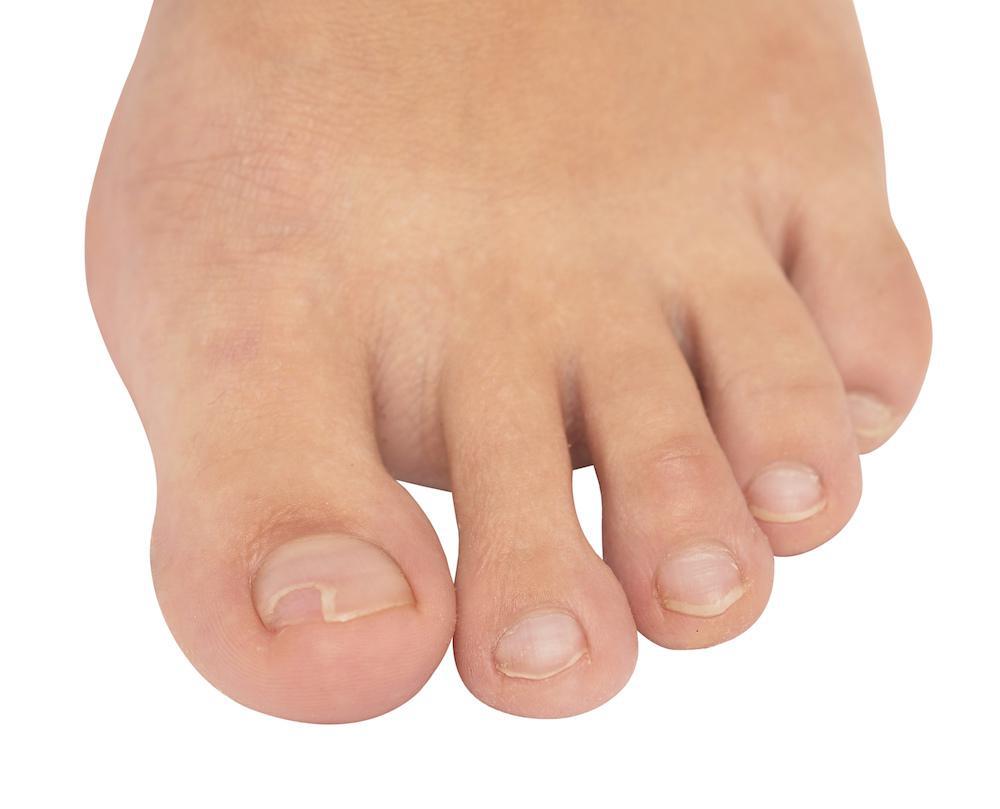 When Does an Ingrown Toenail Require a Visit to the Podiatrist? -  Mountainview Foot and Ankle