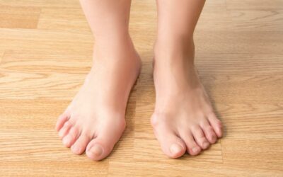 Do Bunions Always Require Medical Intervention?