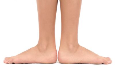 What to do About Flat Feet