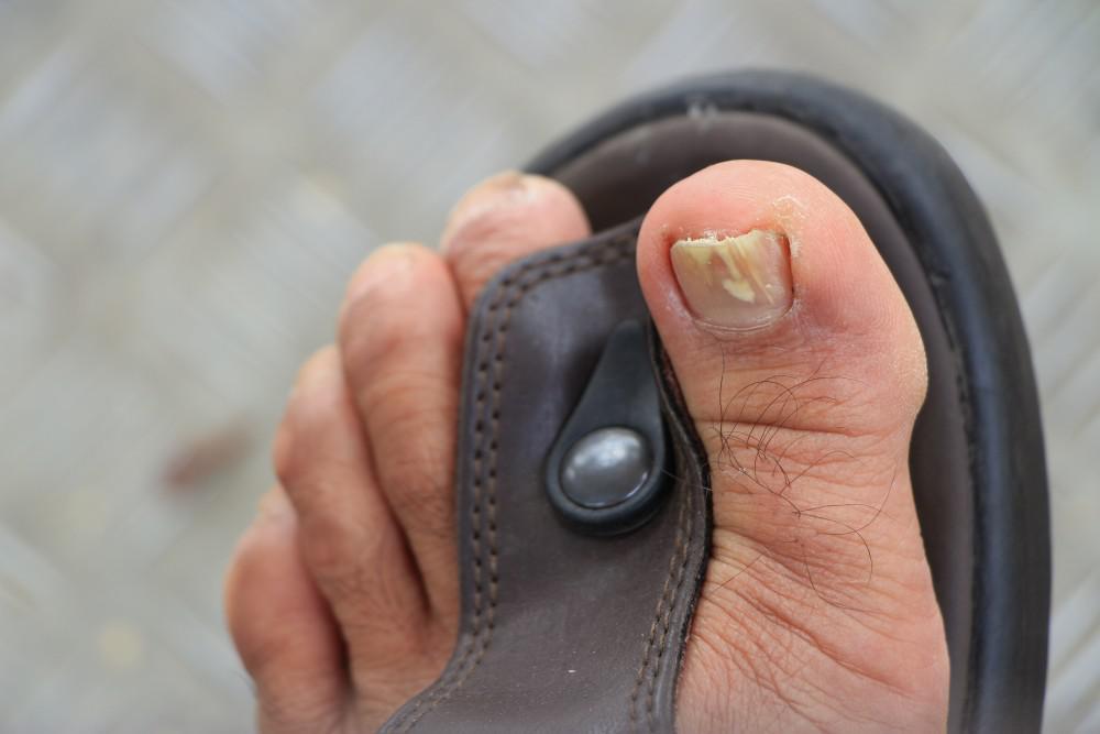 What Causes Toenail Fungus? - Mountainview Foot and Ankle