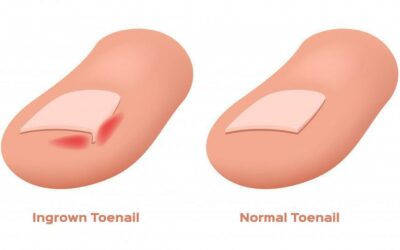 Symptoms of an Ingrown Toenail