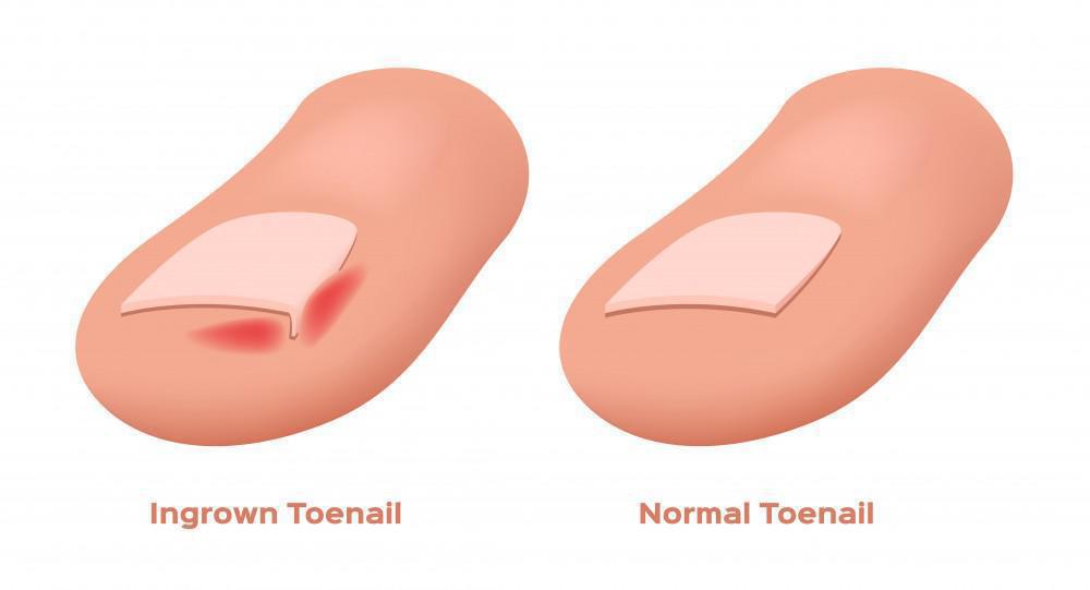 Symptoms of an Ingrown Toenail - Mountainview Foot and Ankle