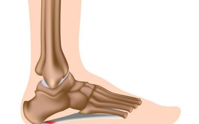 What To Know About Night Splints for Plantar Fasciitis