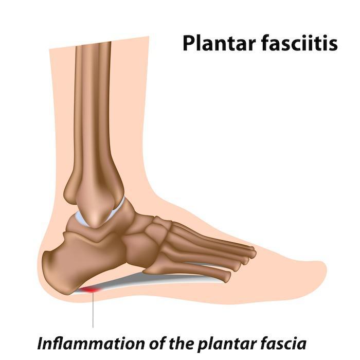 Population prevalence of plantar heel pain and disabling plantar heel... |  Download Scientific Diagram